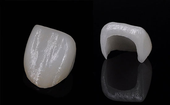 南京全瓷牙套價(jià)格表